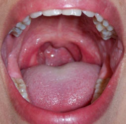 Lump Inside Throat 82